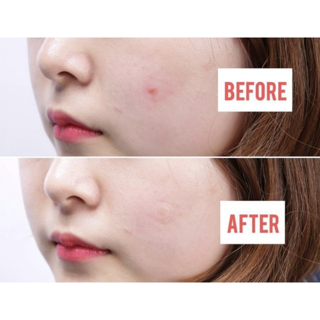 مجموعة مكونة من 18 لاصقة لعلاج حبوب الشباب بالمكونات الطبيعية من ناسيفيك